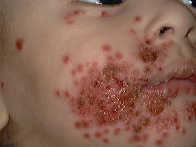 Chicken Pox and Eye Problems - Treato
