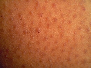 KERATOSIS PILARIS