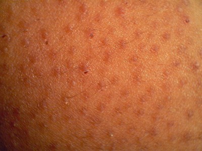 KERATOSIS PILARIS - Pediatrics Board Review - PBR Members Section