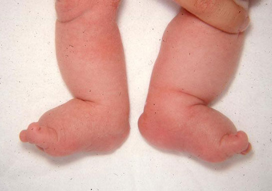 a discussion of turners syndrome Turner syndrome is characterized by short stature and is frequently associated with a variable spectrum of somatic features including ovarian failure discussion. a discussion of turners syndrome Turner syndrome is characterized by short stature and is frequently associated with a variable spectrum of somatic features including ovarian failure discussion.